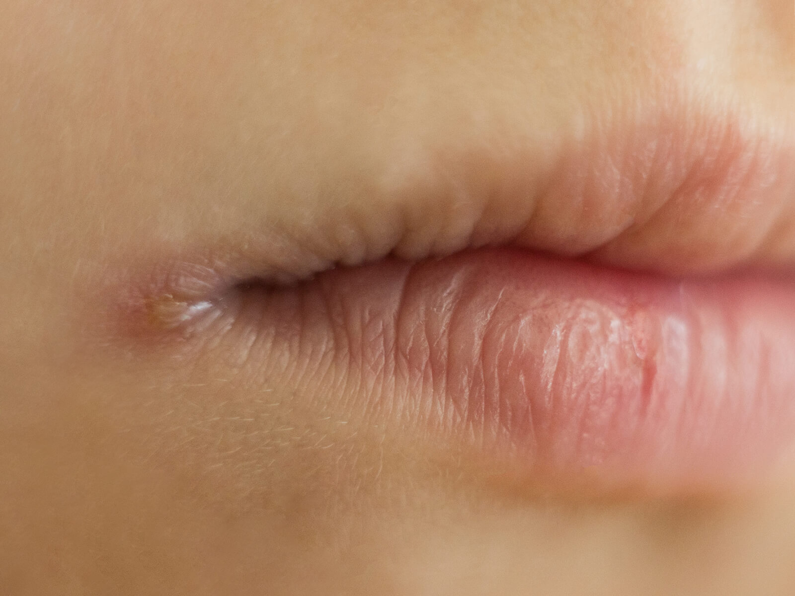 What Foods Cause Angular Cheilitis 