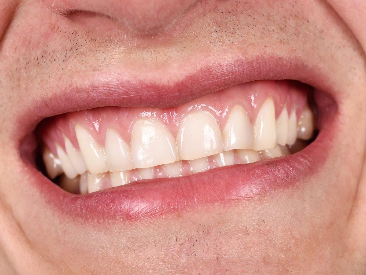 How often do veneers need replacing?