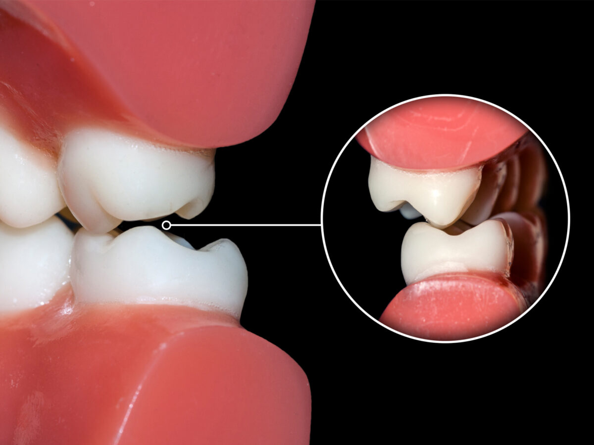 What Causes Occlusion Of Teeth?