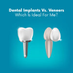 Dental Implants Vs. Veneers