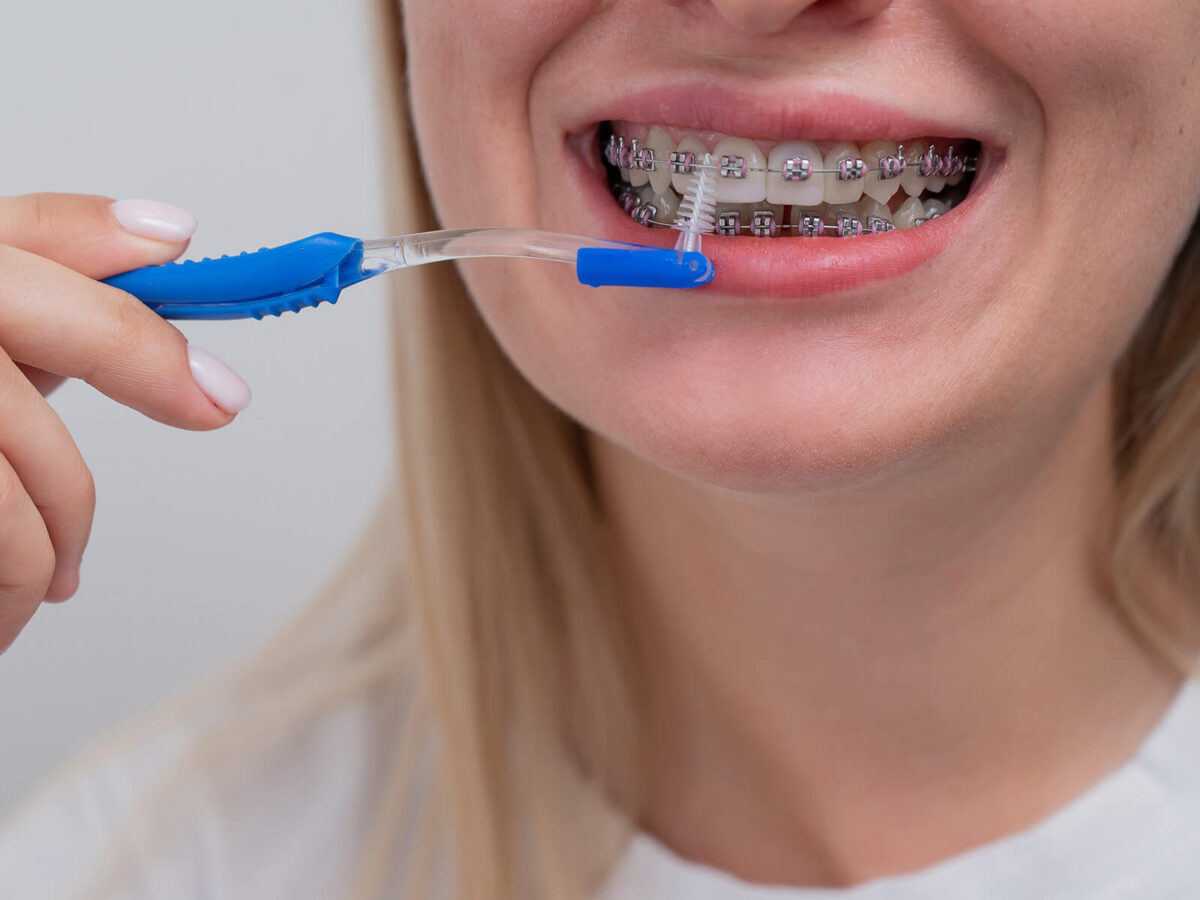 Maintaining Good Oral Hygiene During Orthodontic Treatment