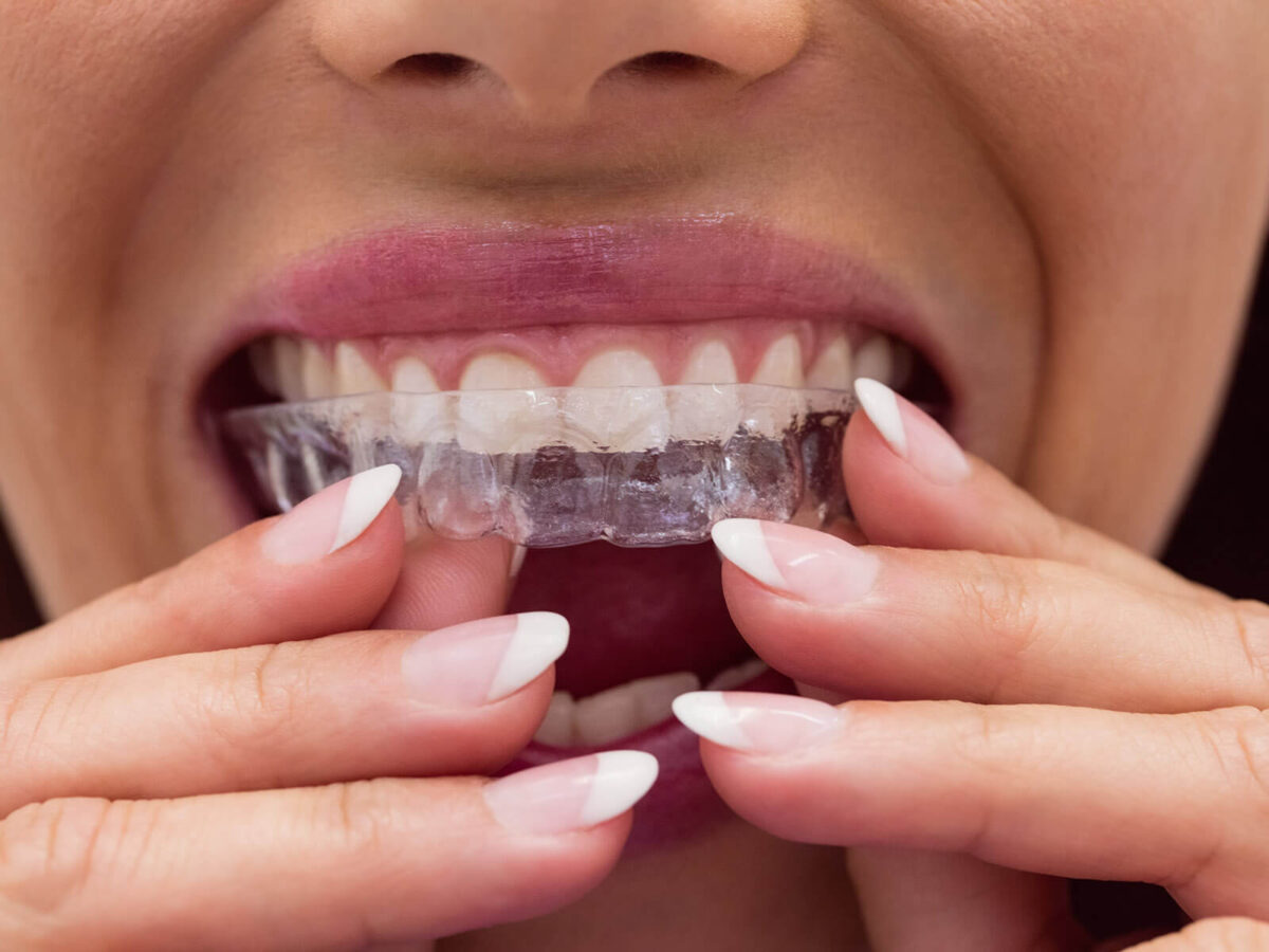 How To Get Effective Relief From Invisalign Pain