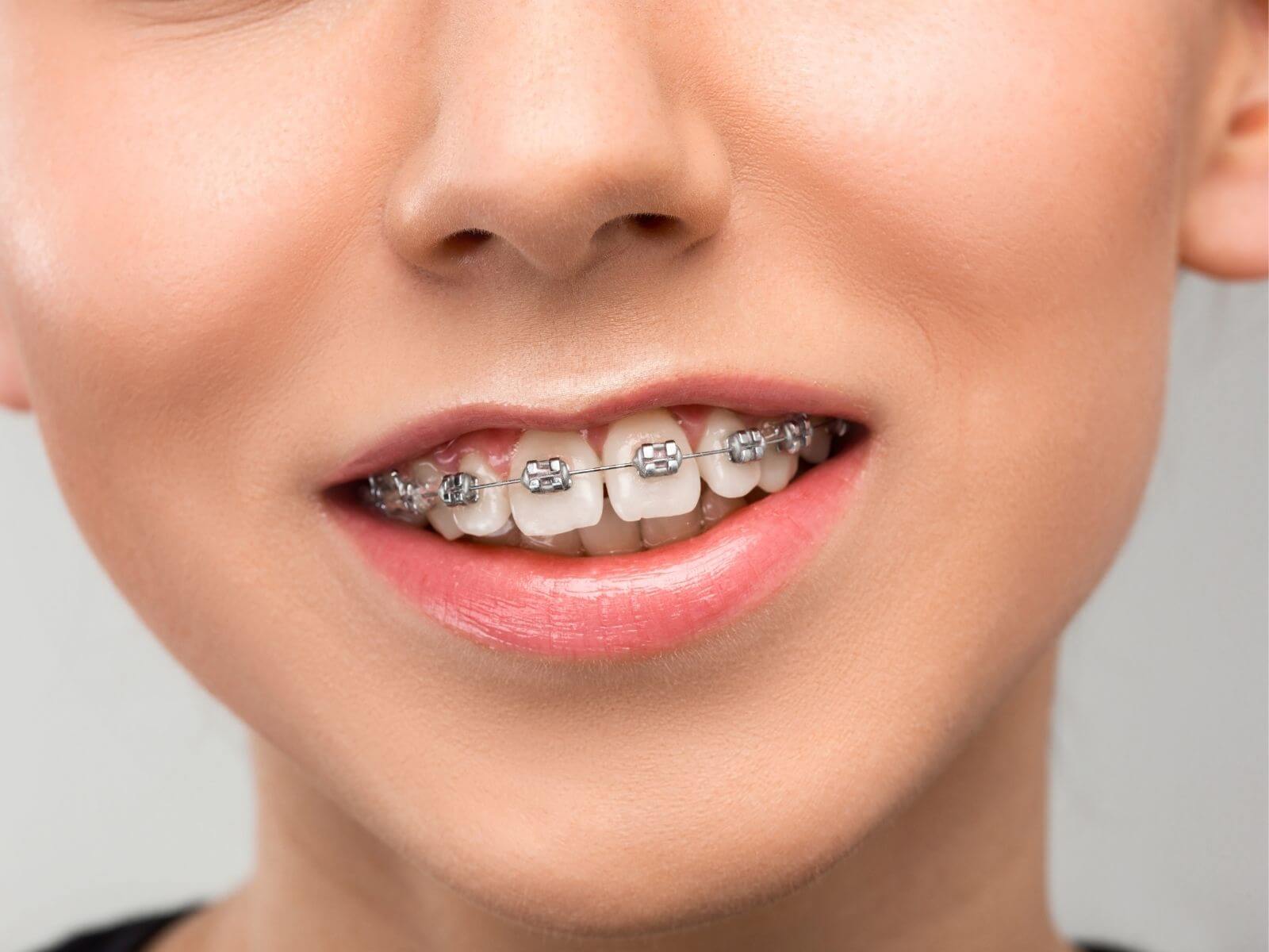 How To Fix An Underbite or Overbite With Braces