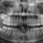 Wisdom Teeth Removal: 6 Recovery Tips And What To Avoid