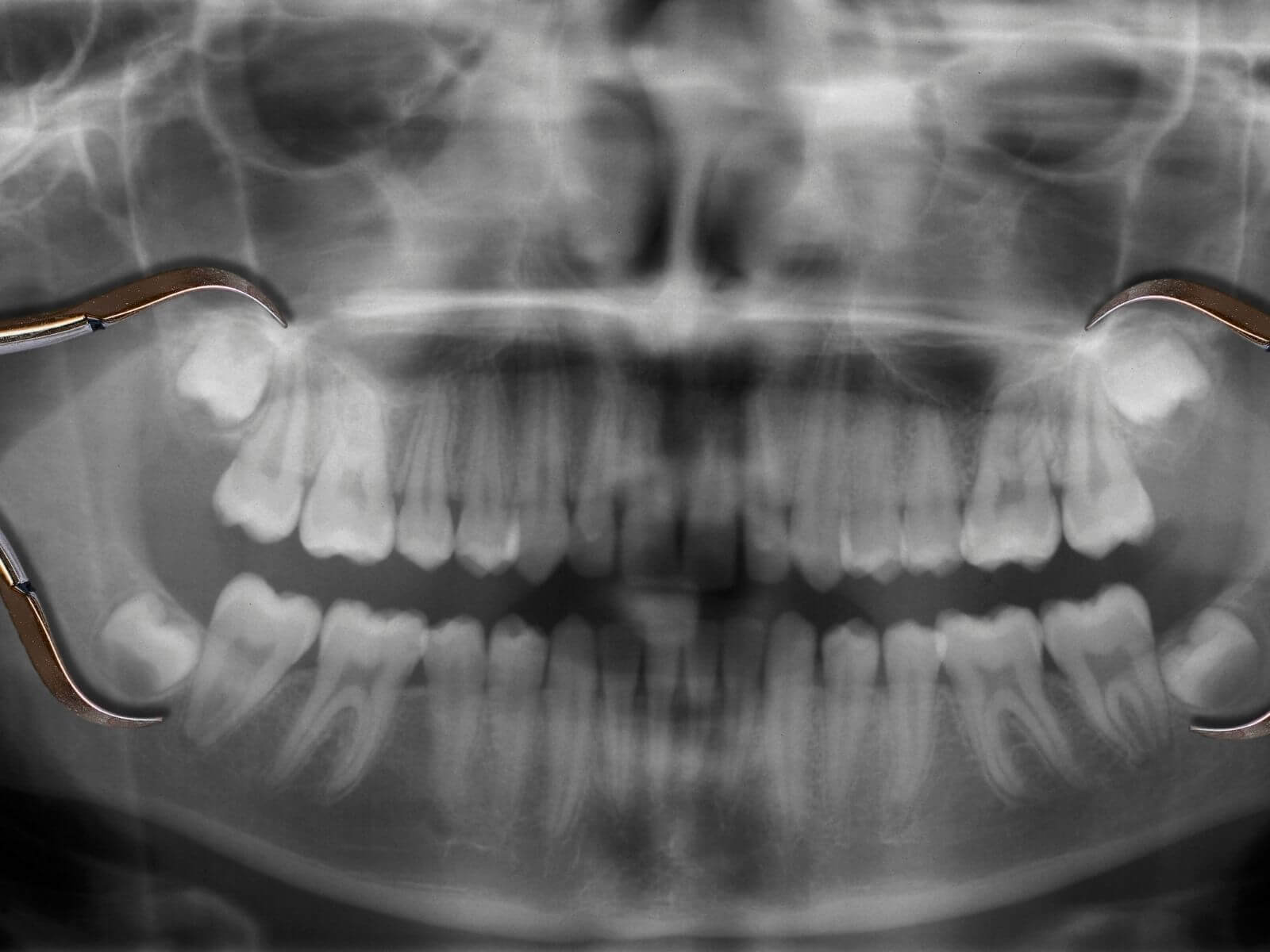 Wisdom Teeth Removal: 6 Recovery Tips And What To Avoid